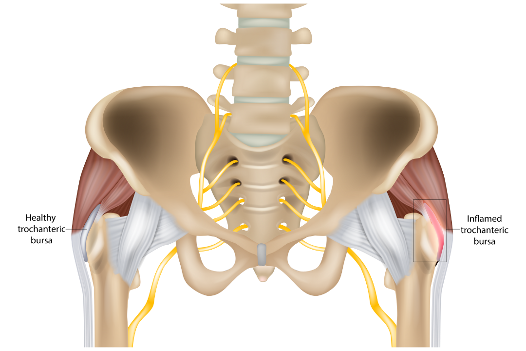 What Is Hip Bursitis And How You Can Treat It · Alm Remedial